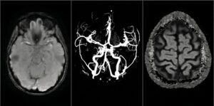Imagen ilustrativa de migraña