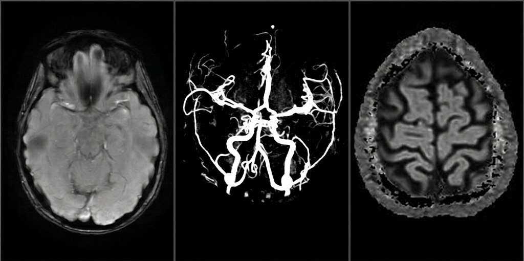 Diario de migrañas (I)