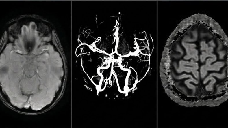 Imagen ilustrativa de migraña